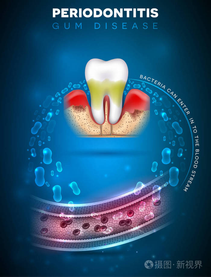 下载小样发票合同问题/举报龋齿疾病炎症并发症牙龈腹腔疾病信息海报