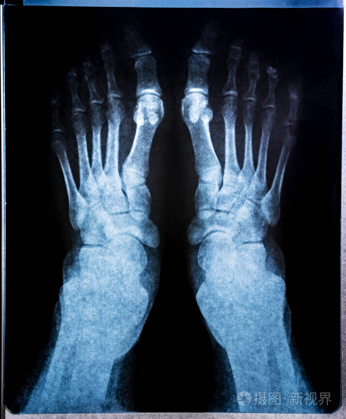照片 关节脚的x射线图像. 计算机断层扫描的研究.jpg