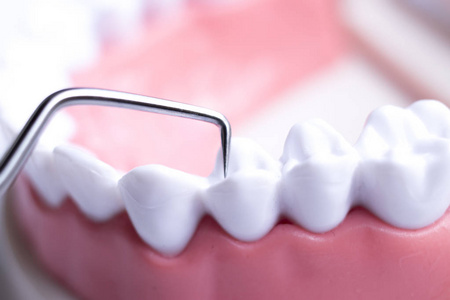 牙科医生用钛金属剔牙仪清洁牙齿，去除牙斑和蛀牙。
