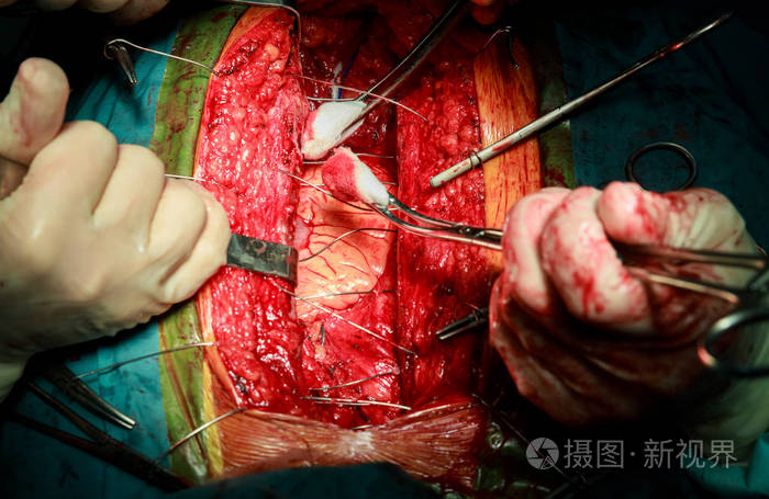 医院病房心脏手术后关闭胸腔