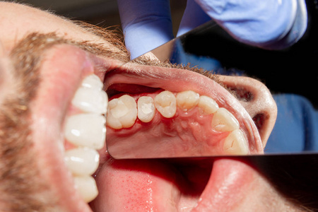 在牙科诊所的治疗阶段关闭一颗人类腐烂的龋齿。 橡胶坝系统与乳胶围巾和金属夹生产光聚合复合填料
