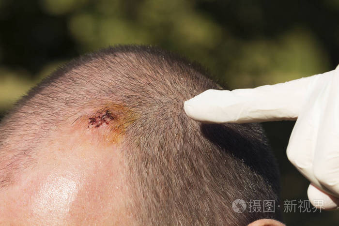 医生指着缝针后的疤痕