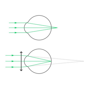 远视远视远视和带眼镜的远视矫正