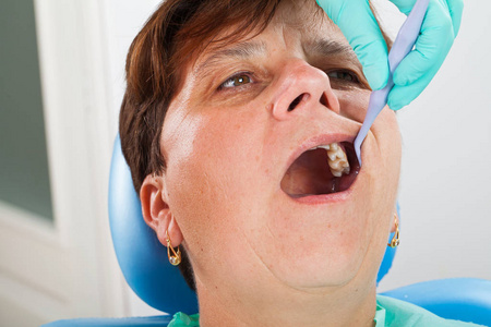 戴牙椅的资深妇女，嘴张着，不敢进行牙科治疗