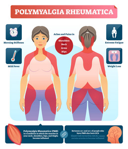 风湿性多肌痛向量例证。标记诊断图