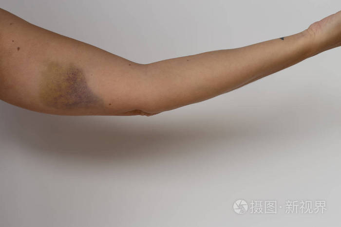 手臂上的瘀伤或血肿照片-正版商用图片13pzxz-摄图新视界