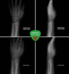 手腕的X射线。 半径骨膜下骨折。 30天后。 合并。 标记。