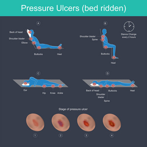 压力溃疡是皮肤的损伤，主要是由皮肤上的长期压力引起的。 它们可能发生在任何人身上，但通常会影响被困在床上或长时间坐在椅子或轮椅上