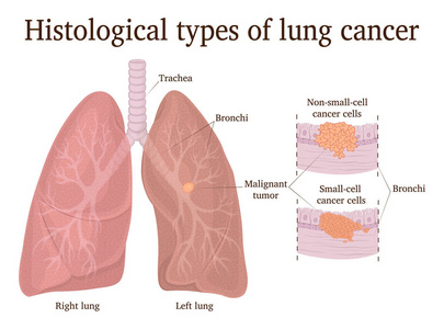 肺癌小细胞和非小细胞的组织学类型