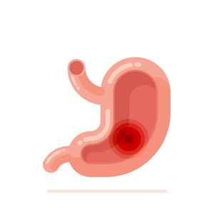 人胃与胃溃疡病概念平面设计矢量图