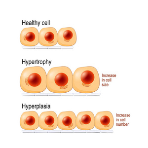 正常细胞肥大是细胞数量增加导致细胞大小增生的增加. 不一样.