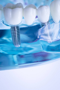 牙科牙齿教学模型显示钛金属牙齿种植螺钉。