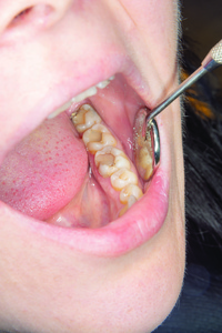 堵牙的材料掉了图片-堵牙的材料掉了素材-堵牙的材料掉了插画-摄图新