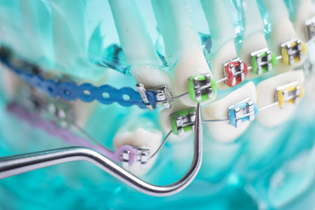 牙科金属牙套，牙齿固定器，教授正畸模型。