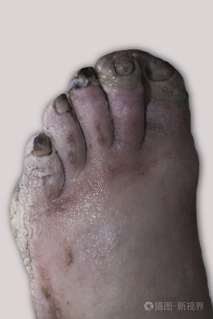 冻伤了男人的腿脏了,腿痛了,有坏疽
