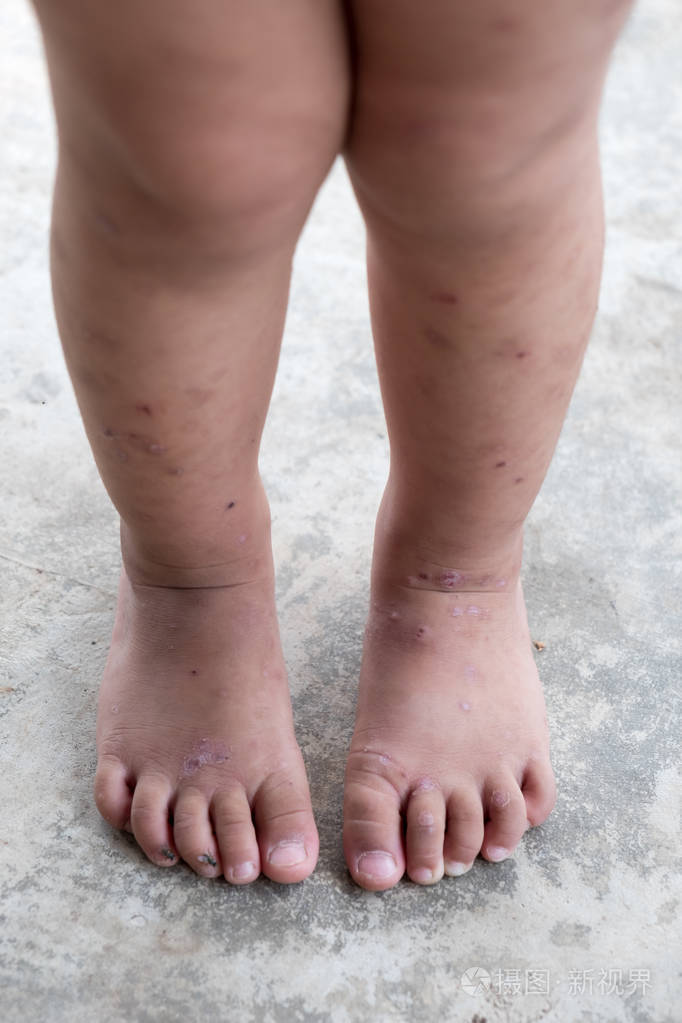 瘙痒性皮炎特应性婴儿足. 关闭感染的伤口,左腿处的伤口.