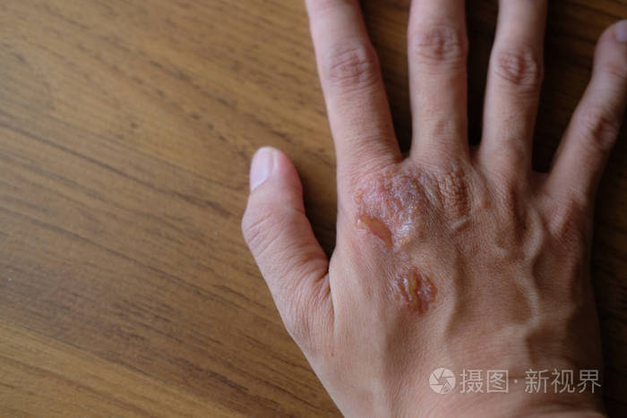 女性手上寻常型银屑病真菌湿疹伴脓 皮肤干燥的皮疹问题照片 正版商用图片14b3v4 摄图新视界 女性手上寻常型银屑病真菌湿疹伴脓 皮肤干燥的皮疹问题照片 正版商用图片14b3v4 摄图新视界