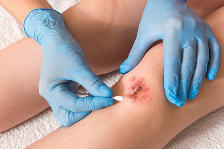 受伤的腿伤膝盖有血,医生双手戴蓝色医疗手套治疗病人伤口照片