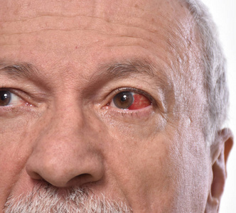 在白色背景上有愤怒的红血球眼的老人照片
