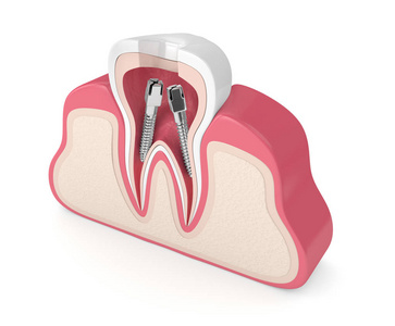 牙床与牙根管柱的三维渲染