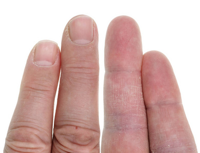 老年人手指上有干燥和酸痛的皮肤。 孤立的白色工作室宏