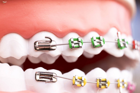 牙科金属牙套,牙齿固定器,教授正畸模型.照片