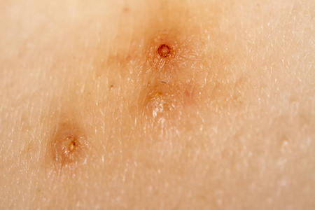 伊波拉病毒图片