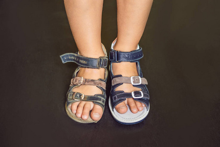 儿童脚在新旧幼稚的矫形凉鞋与拱形支撑.照片