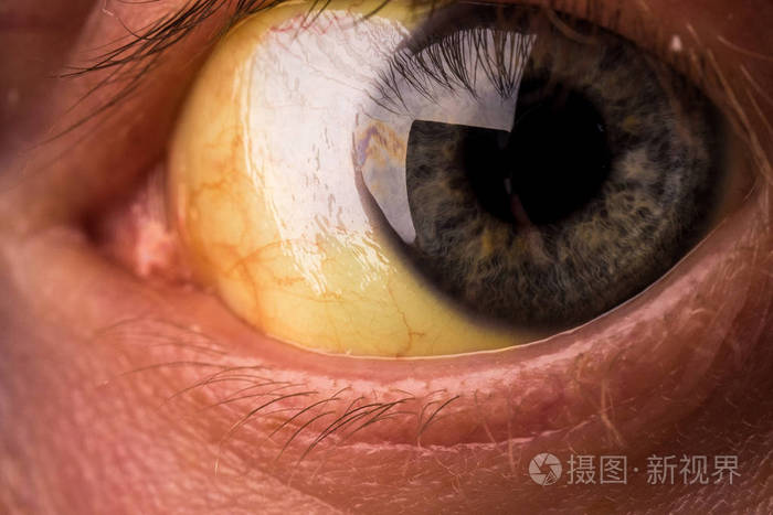 阻塞性黄疸,眼睛严重发黄变色.
