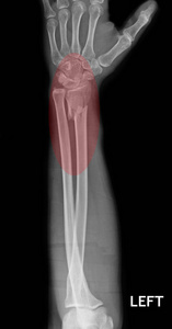  ulnar bone, xray film