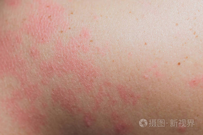 闭合过敏性皮疹周围人的皮疹皮炎问题过敏性皮疹和健康问题的背景图