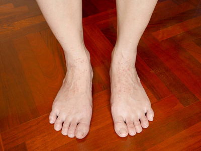 s feet caused by allergic eczema. Health and skin problems.