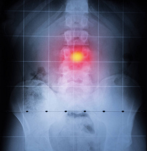 人体X线脊柱和骨盆。 背部疼痛突出红色