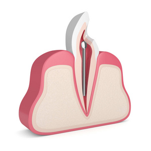 牙齿的三维渲染与牙科不锈钢柱在牙龈上的白色。 牙髓治疗概念