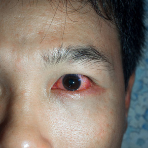 眼睛发红眼睛发红和炎症结膜炎.照片