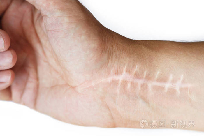 手术后手腕上有缝线的疤痕 在白色背景下孤立的手骨骨折照片 正版商用图片15g6na 摄图新视界