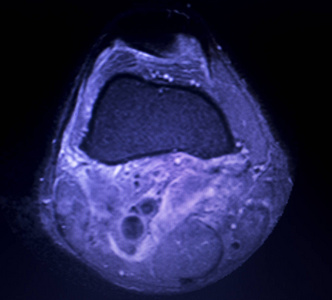 磁共振成像MRI膝后角内侧半月板撕裂最少的结果。