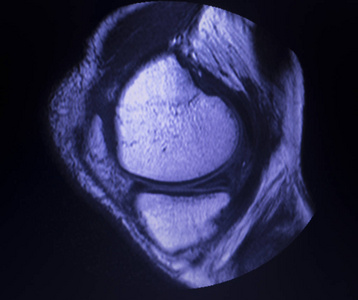 磁共振成像MRI膝后角内侧半月板撕裂最少的结果。