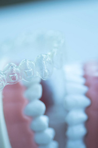 隐形牙对齐托槽，用于对每颗牙齿在美容牙科为病人。