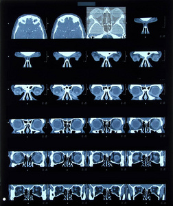 头颅骨的ct