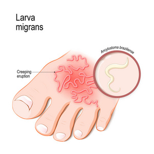 皮肤幼虫迁移。 由钩虫引起的人类皮肤病盲孢梭菌。 医学生物科学和教育用途矢量图