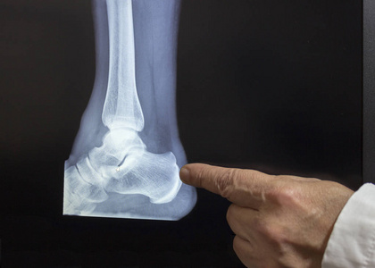 一张鞋跟的X光照片，女巫医生的手指向骨折处