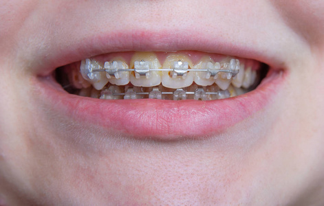 s face with open mouth and braces on her teeth. Details of teeth