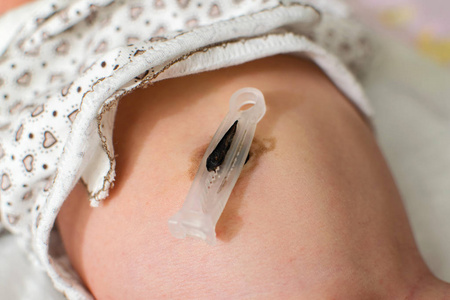 新生儿肚脐-脐带剪新生儿肚脐的护理