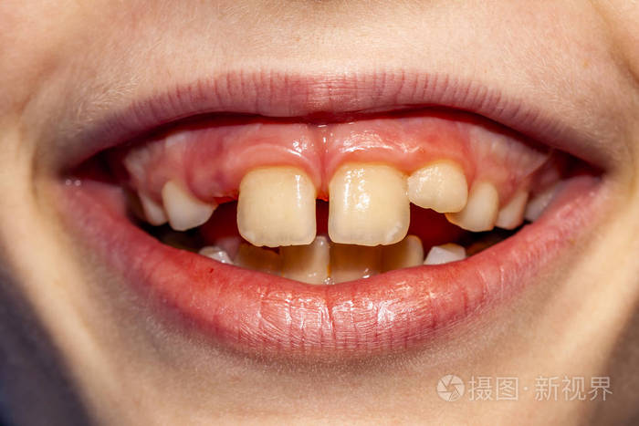 8岁儿童在手术切除乳牙后出现治疗后10个月不拔掉婴儿牙齿的问题