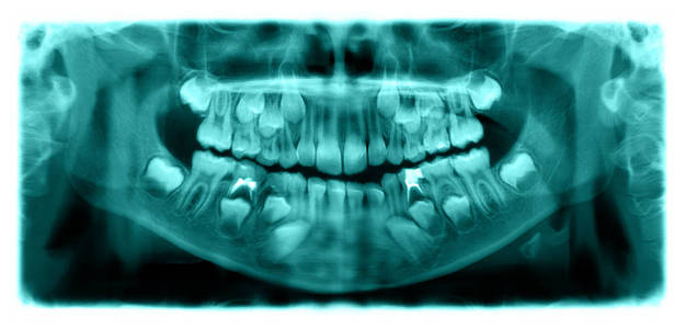 全景X线片是一个7岁儿童上颌骨和下颌骨下颌骨的扫描牙科X线。这幅图像是绿色的。