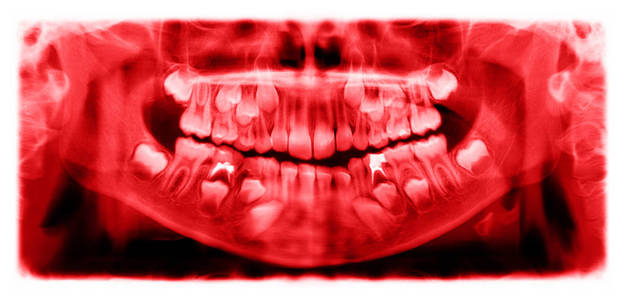 全景X线片是一种扫描牙科x射线的上颌骨和下颌骨7岁的儿童。 这个图像是红色的。