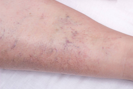 静脉曲张在皮肤上的血管标记, 皮肤上的血管图案, 特写, 静脉疾病