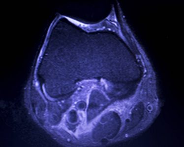 磁共振成像MRI膝后角内侧半月板撕裂最少的结果。