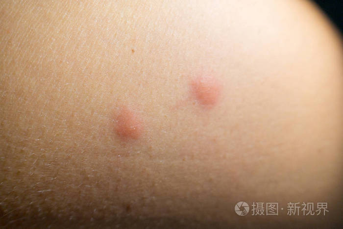 女性手部的昆虫叮咬